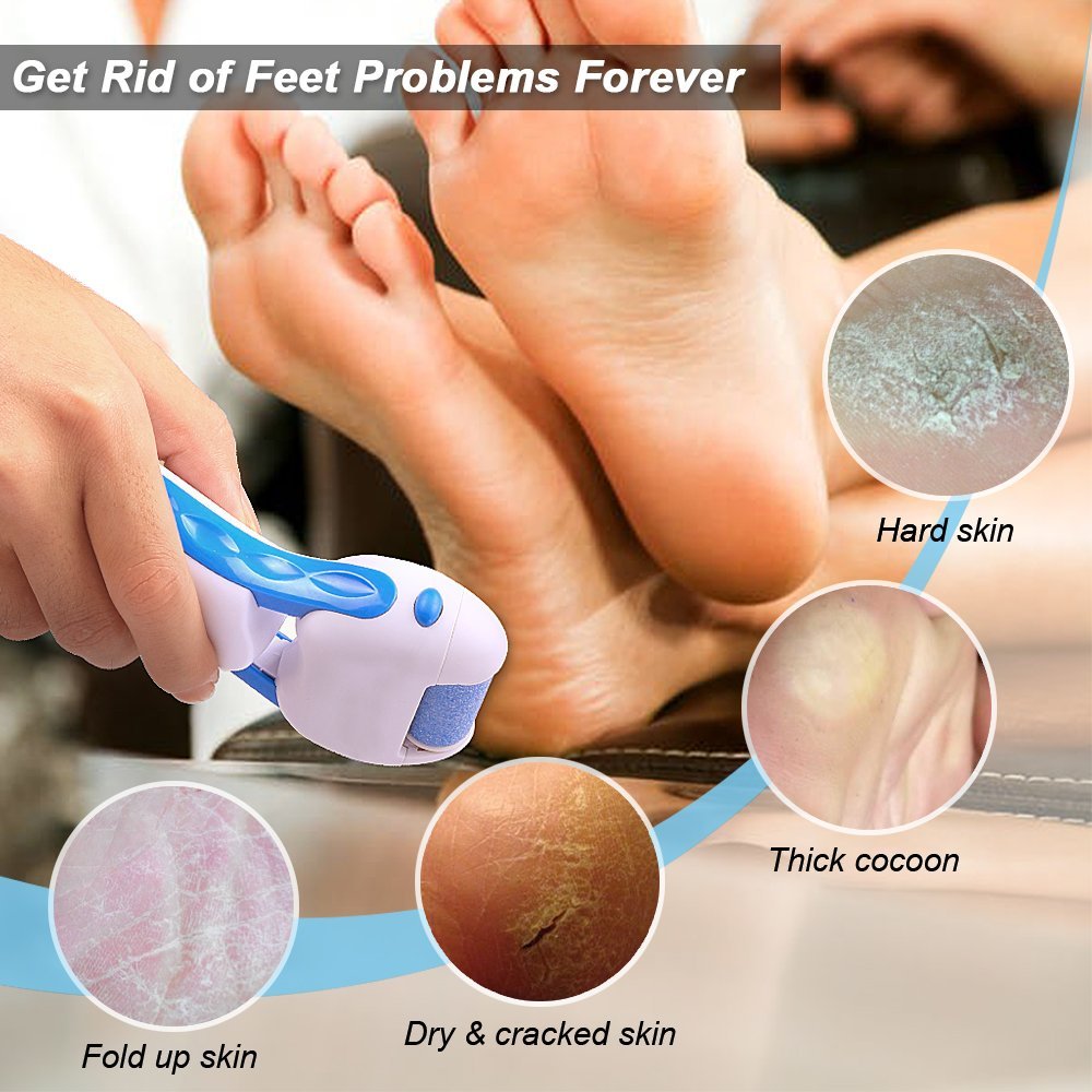 get rid of hard skin on feet